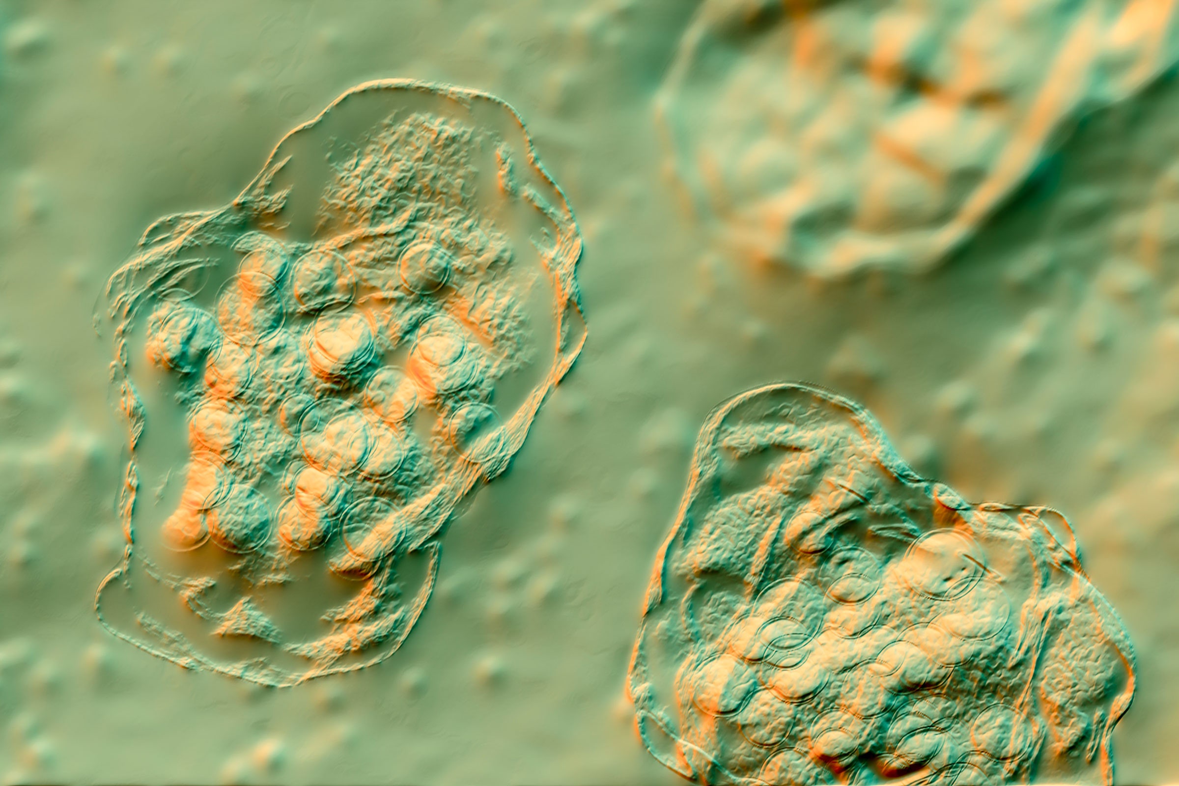 Measles Strikes a Florida Elementary School With Over 100 Unvaccinated Kids